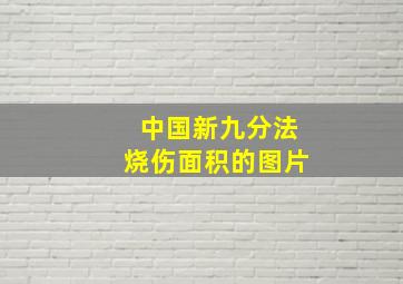 中国新九分法烧伤面积的图片