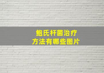 鲍氏杆菌治疗方法有哪些图片